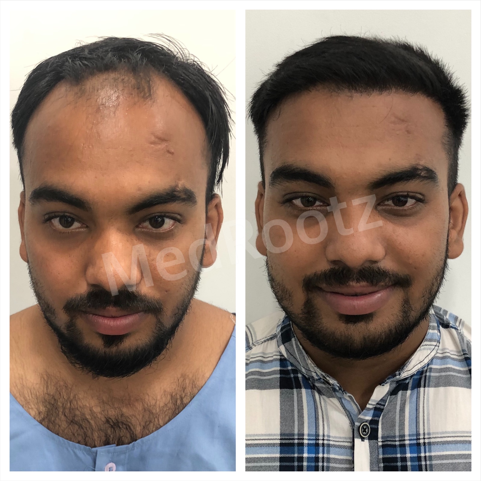Best hair transplant doctor in delhi
